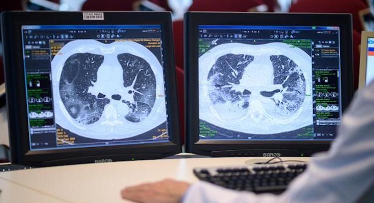 Study Shows Asymptomatic Coronavirus Patients Could Have Long-Term Lung Damage