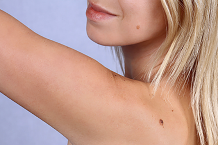 Yale Researchers Develop Skin Cancer Injection, No Surgery Required