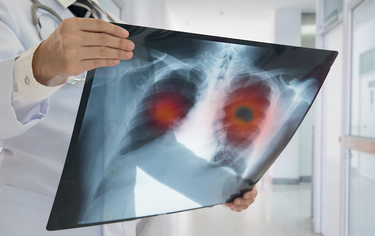 New Guidance Advocates For More People To Be Screened For Lung Cancer